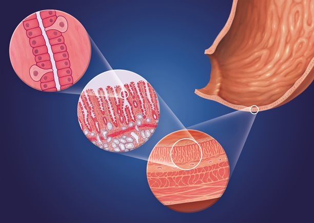 Grafik eines Magenteils mit Lupeneffekten der Schleimhaut. Darstellung der säureproduzierenden Magenzellen