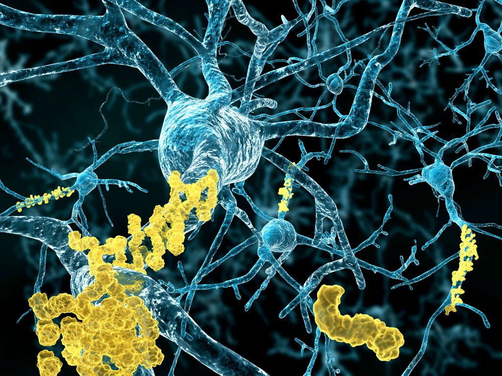 Neurons with amyloid plaques