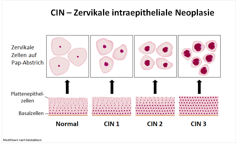 CIN- Zervikale intraepitheliale Neoplasie