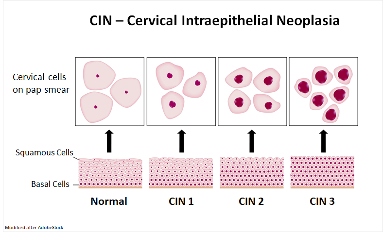 CIN - cervical intraepithelial neoplasia