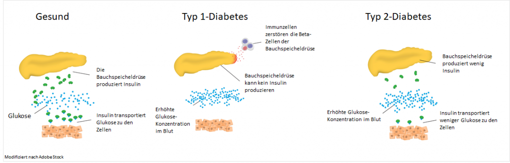 Charakterisierung von Typ 1 und Typ 2 Diabetes