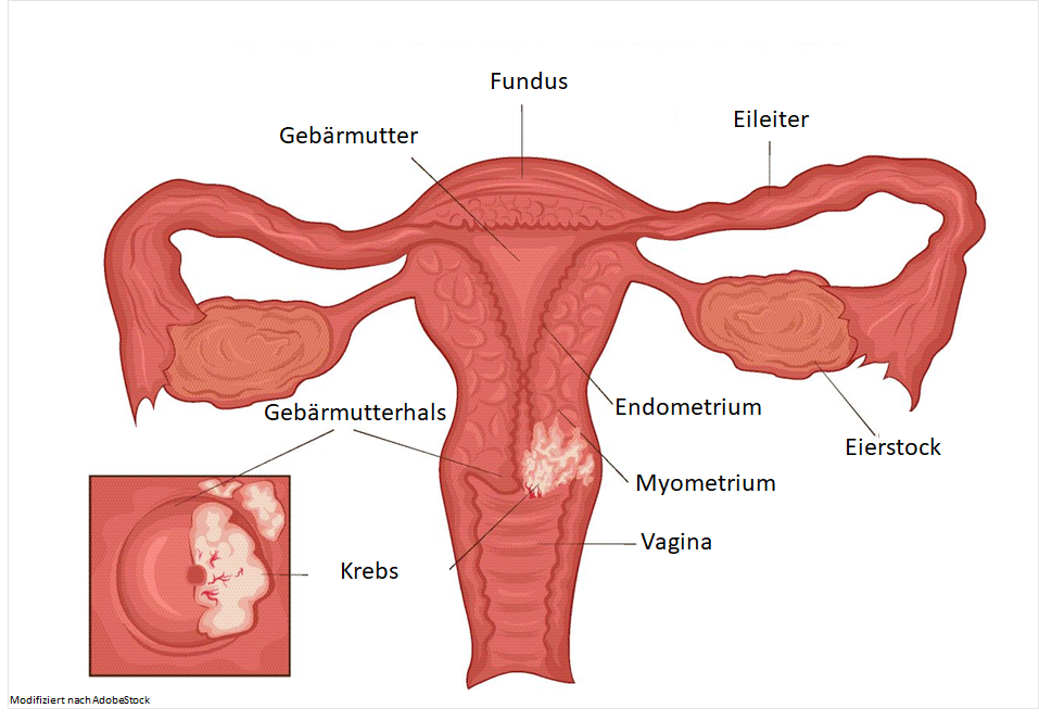 Darstellung von Gebärmutterhalskrebs