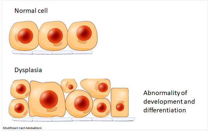 Difference between normal cells and dysplasia