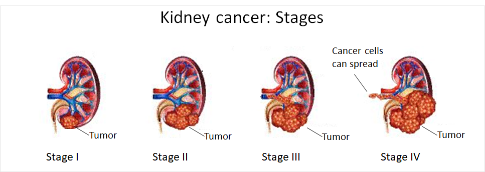 Kidney cancer_stages